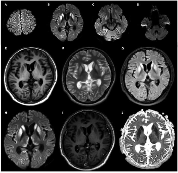 https://cdn.ncbi.nlm.nih.gov/pmc/blobs/e370/9263511/56ea64afc51f/fneur-13-888309-g0003.jpg