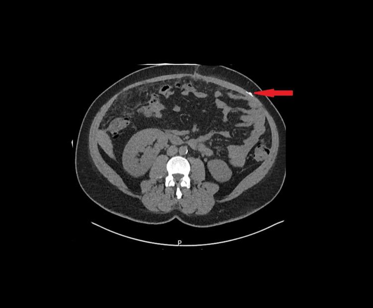 https://cdn.ncbi.nlm.nih.gov/pmc/blobs/e37d/12301637/ab64989f14e4/cureus-0017-00000086892-i03.jpg