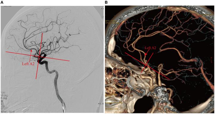 https://cdn.ncbi.nlm.nih.gov/pmc/blobs/e3be/7509403/05997b6c34d7/fneur-11-01020-g0007.jpg