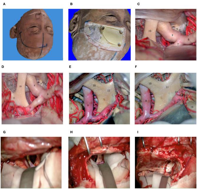 https://cdn.ncbi.nlm.nih.gov/pmc/blobs/e3be/7509403/ab54211d23cb/fneur-11-01020-g0005.jpg