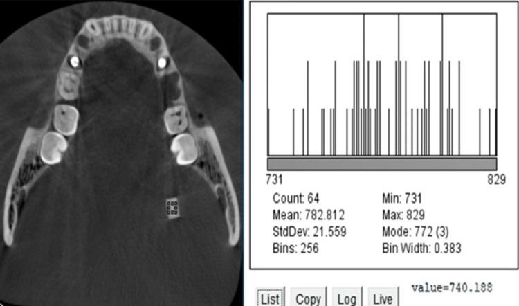 https://cdn.ncbi.nlm.nih.gov/pmc/blobs/e3db/10122839/7530b90dce93/cureus-0015-00000036630-i05.jpg