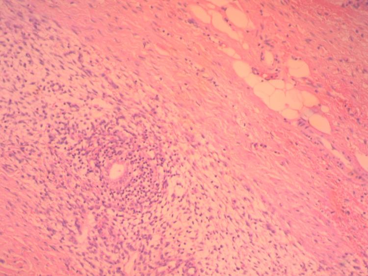 https://cdn.ncbi.nlm.nih.gov/pmc/blobs/e3ed/11655051/dc6494589908/cureus-0016-00000073891-i03.jpg