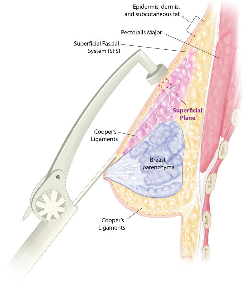 https://cdn.ncbi.nlm.nih.gov/pmc/blobs/e400/9698120/88f7e698569b/prs-150-01200-g005.jpg