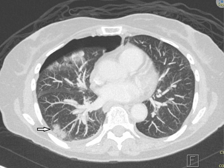 https://cdn.ncbi.nlm.nih.gov/pmc/blobs/e403/12056565/72ed2d3bc063/cureus-0017-00000081816-i04.jpg