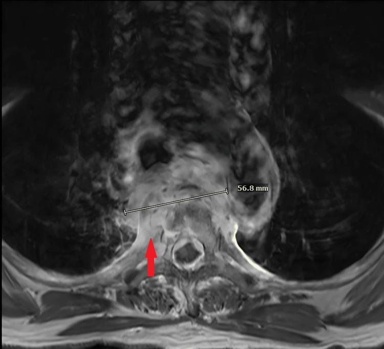 https://cdn.ncbi.nlm.nih.gov/pmc/blobs/e403/12056565/81c052decd21/cureus-0017-00000081816-i02.jpg