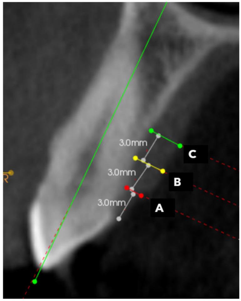 https://cdn.ncbi.nlm.nih.gov/pmc/blobs/e467/12293691/a4da2b5c79b1/dentistry-13-00283-g002.jpg