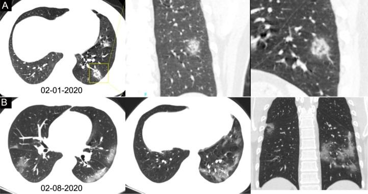 https://cdn.ncbi.nlm.nih.gov/pmc/blobs/e46b/7233399/36b89c70da06/radiol.2020200642.fig3.jpg