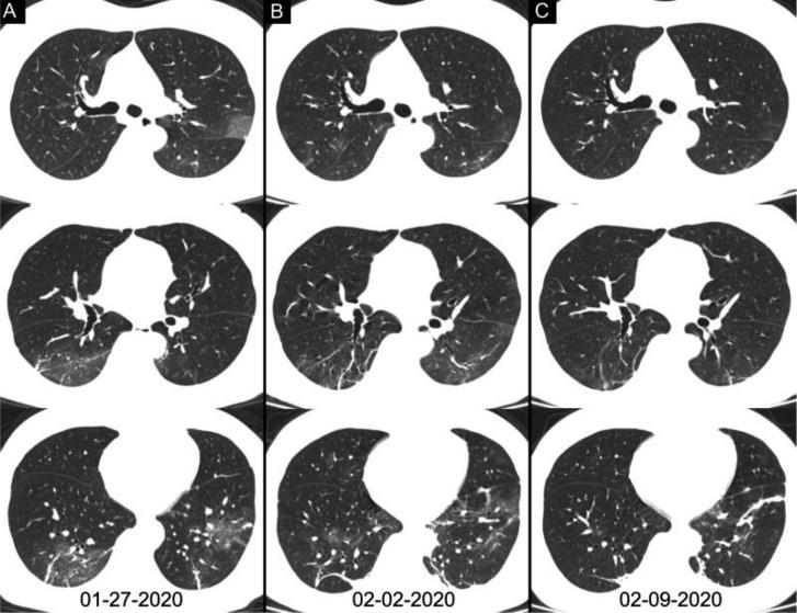 https://cdn.ncbi.nlm.nih.gov/pmc/blobs/e46b/7233399/5111a3143825/radiol.2020200642.fig4.jpg