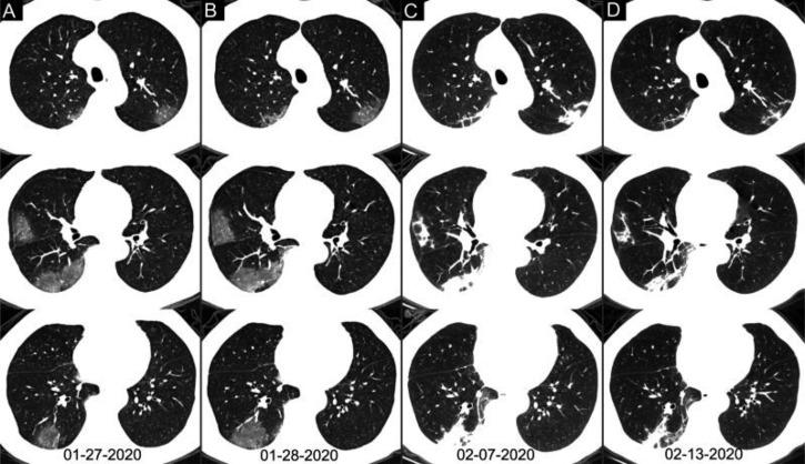 https://cdn.ncbi.nlm.nih.gov/pmc/blobs/e46b/7233399/535f7a79954a/radiol.2020200642.fig5.jpg