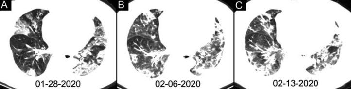https://cdn.ncbi.nlm.nih.gov/pmc/blobs/e46b/7233399/64f5d6be8380/radiol.2020200642.fig6.jpg