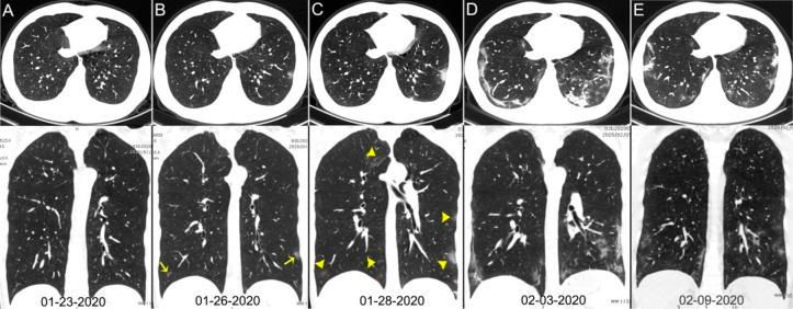 https://cdn.ncbi.nlm.nih.gov/pmc/blobs/e46b/7233399/cab424e49bac/radiol.2020200642.fig2.jpg