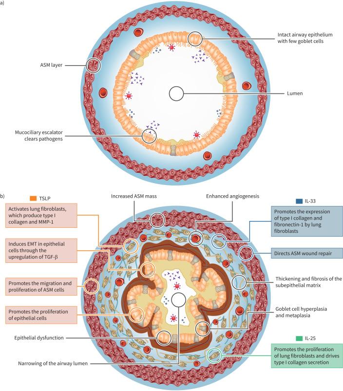 https://cdn.ncbi.nlm.nih.gov/pmc/blobs/e4bb/11024394/341acbf9ca7a/ERJ-01619-2023.01.jpg