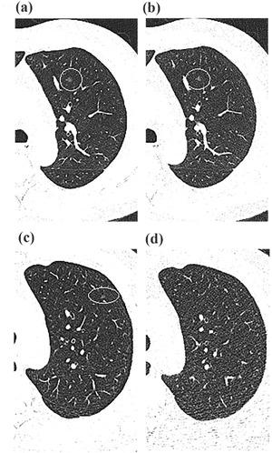 https://cdn.ncbi.nlm.nih.gov/pmc/blobs/e52e/8992951/7f94b1e9b742/ACM2-23-e13589-g005.jpg