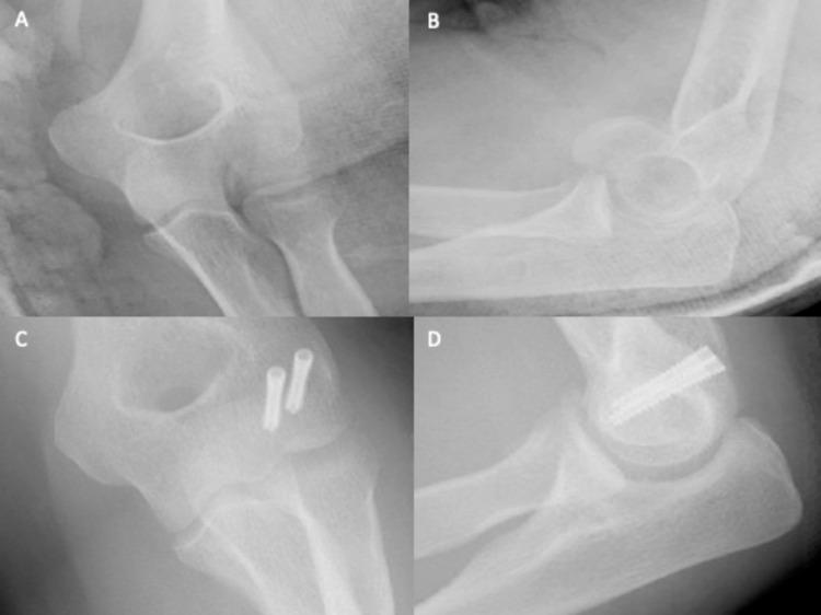 https://cdn.ncbi.nlm.nih.gov/pmc/blobs/e560/11137435/2a7e408a3578/cureus-0016-00000059326-i04.jpg