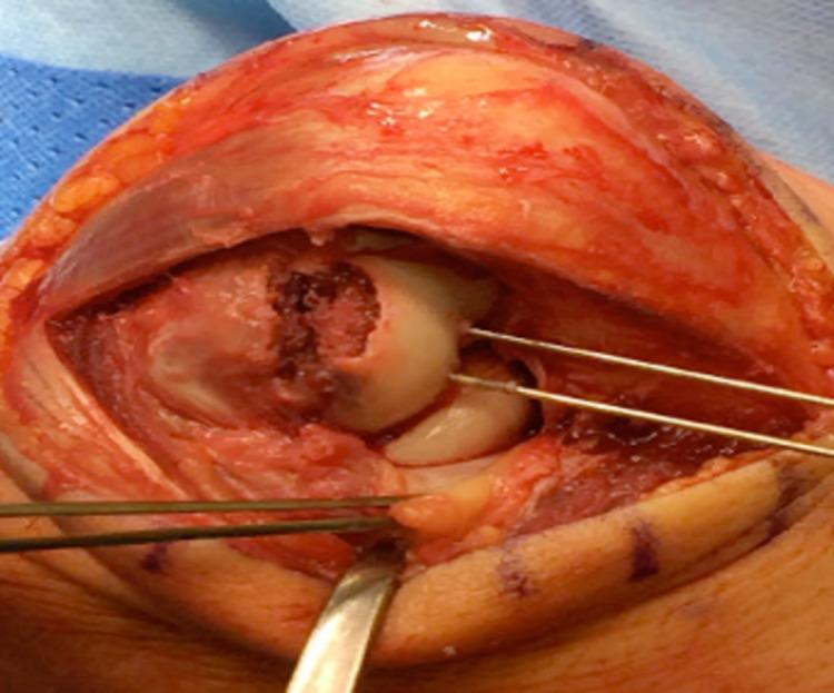 https://cdn.ncbi.nlm.nih.gov/pmc/blobs/e560/11137435/e87e200c004c/cureus-0016-00000059326-i03.jpg