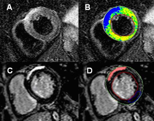 https://cdn.ncbi.nlm.nih.gov/pmc/blobs/e59b/3060149/1637aee8f6d8/1532-429X-13-13-3.jpg