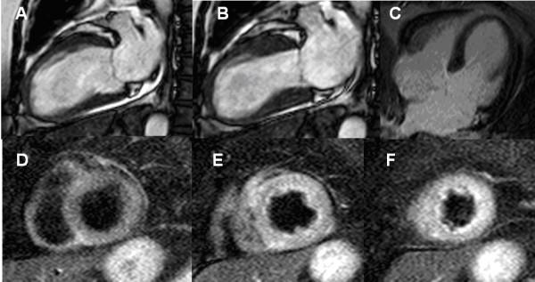 https://cdn.ncbi.nlm.nih.gov/pmc/blobs/e59b/3060149/a8a29716c065/1532-429X-13-13-4.jpg