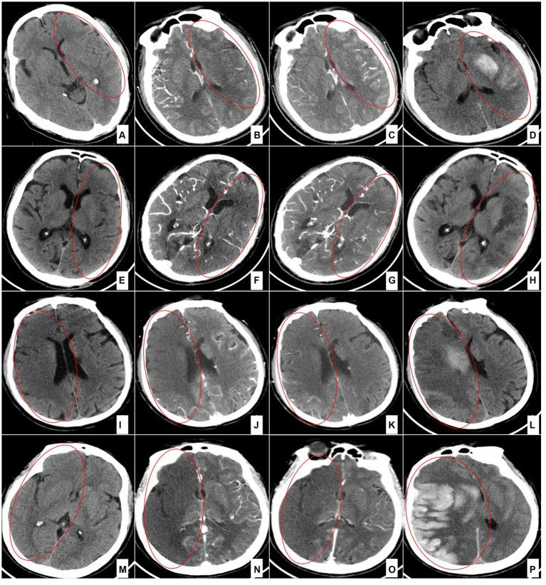 https://cdn.ncbi.nlm.nih.gov/pmc/blobs/e5b0/11148382/5c57f4a33d68/fneur-15-1402003-g001.jpg