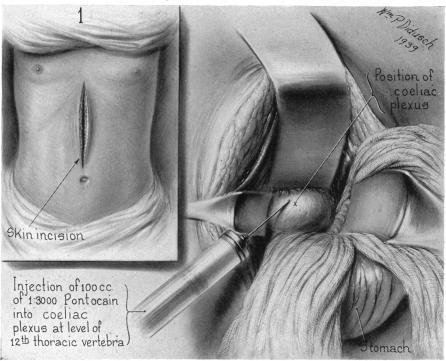 https://cdn.ncbi.nlm.nih.gov/pmc/blobs/e5e3/1391390/60939f5a2480/annsurg00502-0094-a.jpg