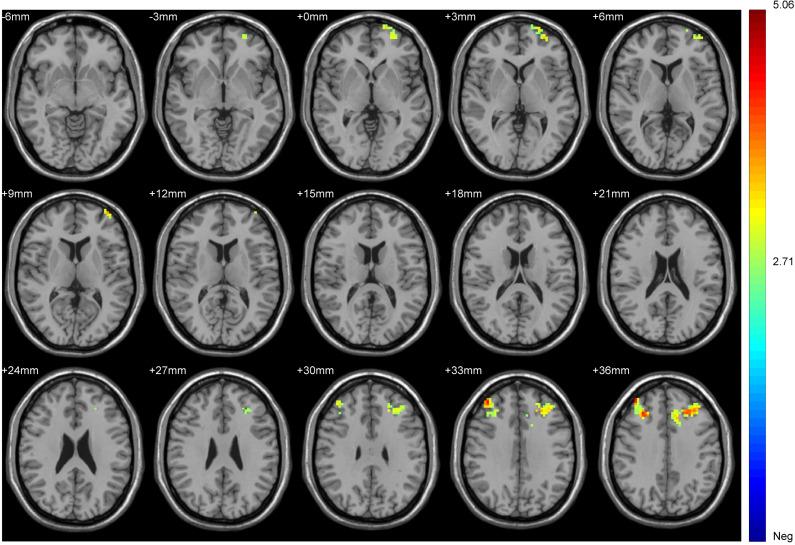 https://cdn.ncbi.nlm.nih.gov/pmc/blobs/e5f0/8703225/53359249f6b2/NDT-17-3753-g0003.jpg
