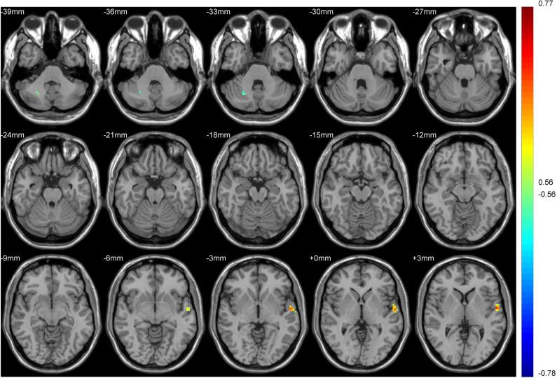 https://cdn.ncbi.nlm.nih.gov/pmc/blobs/e5f0/8703225/ced601bd9dd5/NDT-17-3753-g0007.jpg