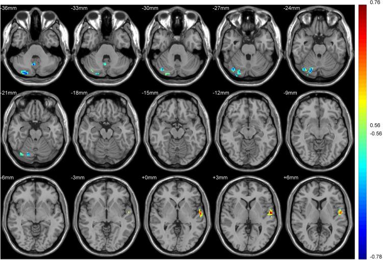 https://cdn.ncbi.nlm.nih.gov/pmc/blobs/e5f0/8703225/d7b1e65879fd/NDT-17-3753-g0009.jpg