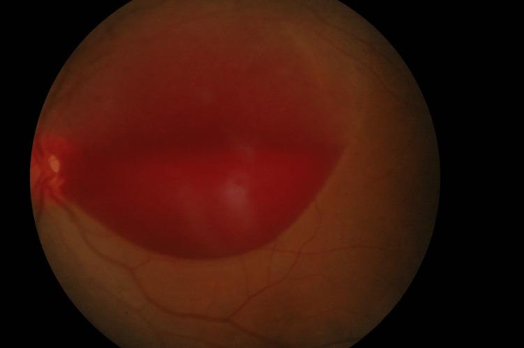 https://cdn.ncbi.nlm.nih.gov/pmc/blobs/e600/10543730/7e725358c383/cureus-0015-00000044420-i01.jpg