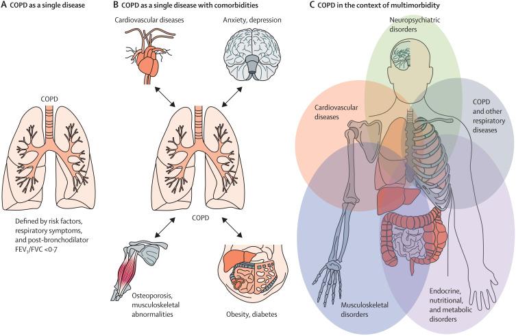 https://cdn.ncbi.nlm.nih.gov/pmc/blobs/e630/10927883/835a5cb44965/COPD-19-567-g0001.jpg