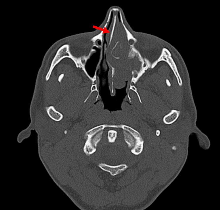 https://cdn.ncbi.nlm.nih.gov/pmc/blobs/e67f/10882638/3fc7d73e8e2e/cureus-0016-00000052781-i02.jpg