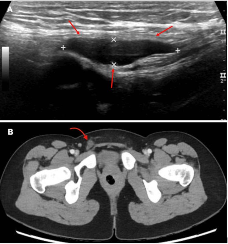 https://cdn.ncbi.nlm.nih.gov/pmc/blobs/e6b6/12168713/a16b7e4737f2/cureus-0017-00000084231-i01.jpg