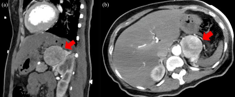 https://cdn.ncbi.nlm.nih.gov/pmc/blobs/e6c7/11040423/5930449494d7/cureus-0016-00000056878-i01.jpg