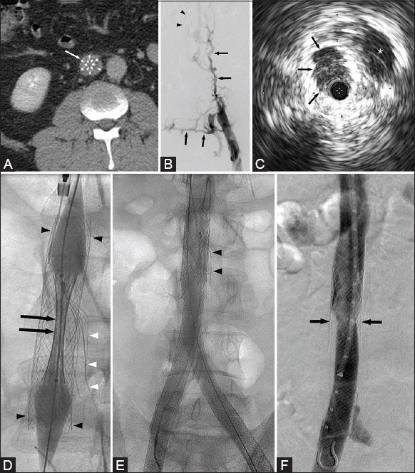 https://cdn.ncbi.nlm.nih.gov/pmc/blobs/e742/4531446/766031bd7659/IJRI-25-233-g002.jpg