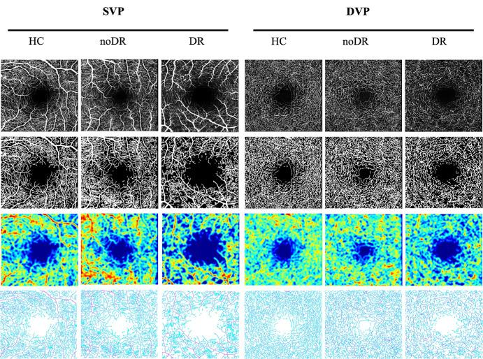 https://cdn.ncbi.nlm.nih.gov/pmc/blobs/e766/11636659/c7d042bcbf78/iovs-65-14-21-f002.jpg