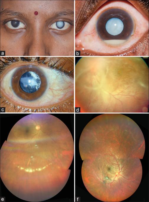 https://cdn.ncbi.nlm.nih.gov/pmc/blobs/e77b/11232860/5d9c15338b35/IJO-72-869-g002.jpg