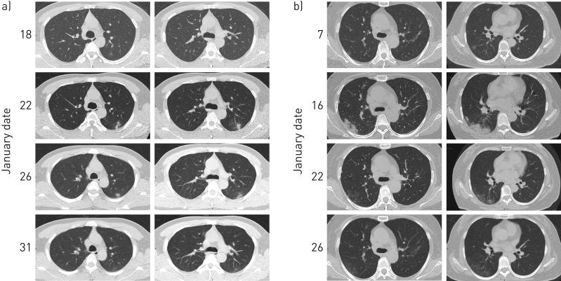 https://cdn.ncbi.nlm.nih.gov/pmc/blobs/e79c/7236818/3a1e766e8ad5/ERJ-00544-2020.03.jpg