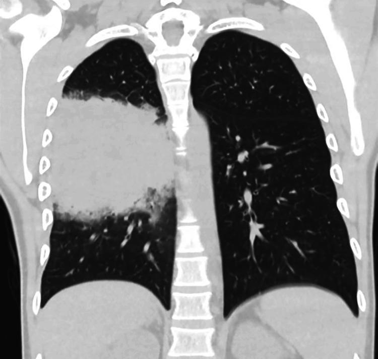 https://cdn.ncbi.nlm.nih.gov/pmc/blobs/e7f8/10770579/e19cc7a26fa3/cureus-0015-00000050088-i04.jpg