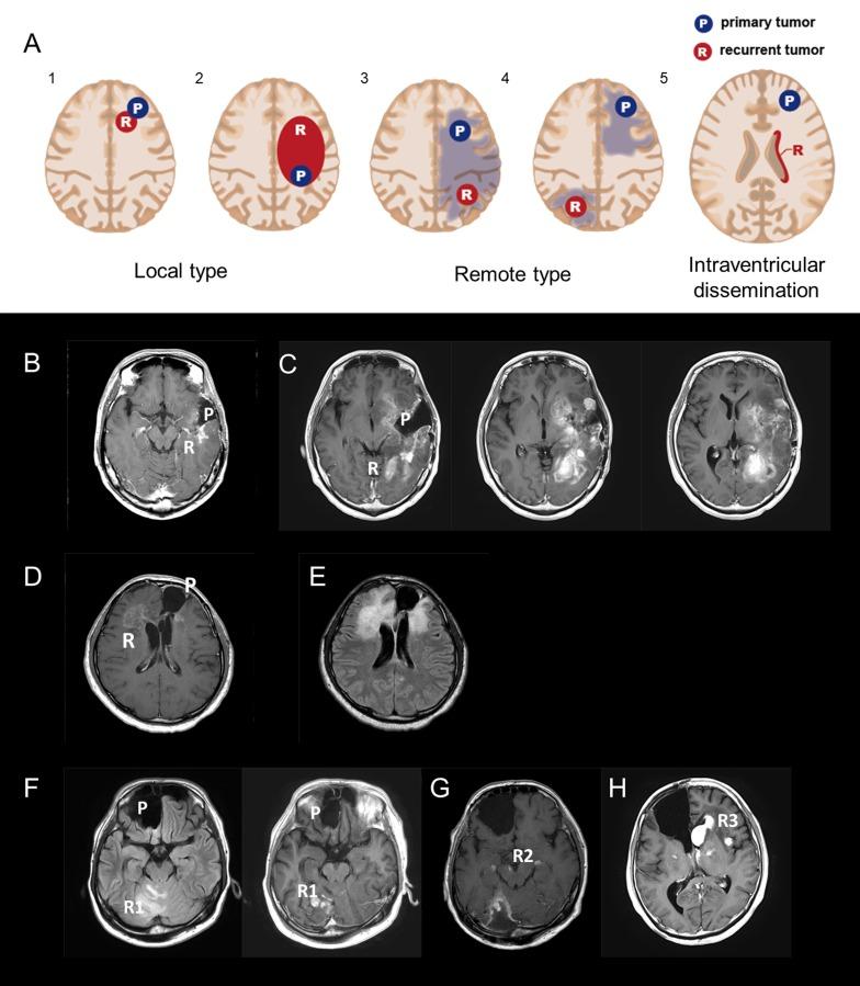 https://cdn.ncbi.nlm.nih.gov/pmc/blobs/e899/5689569/eacc11e87fd3/oncotarget-08-84729-g001.jpg