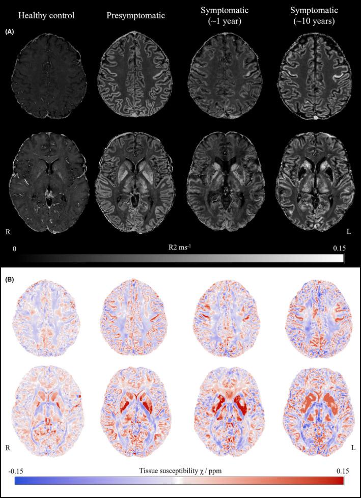 https://cdn.ncbi.nlm.nih.gov/pmc/blobs/e8cc/11093244/497215d1a53e/ACN3-11-1359-g001.jpg