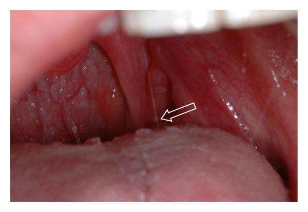 https://cdn.ncbi.nlm.nih.gov/pmc/blobs/e8f2/3920671/5f564e850c8c/ISRN.DENTISTRY2014-839635.001.jpg