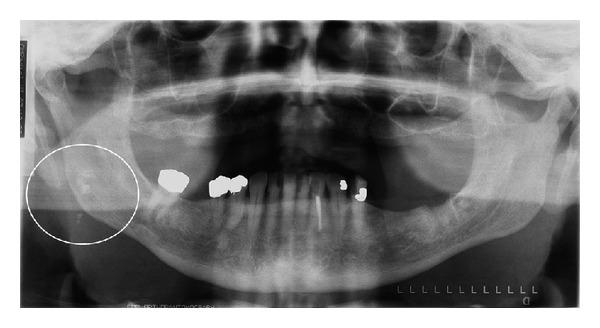 https://cdn.ncbi.nlm.nih.gov/pmc/blobs/e8f2/3920671/6c1c362c3991/ISRN.DENTISTRY2014-839635.002.jpg