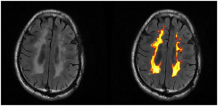 https://cdn.ncbi.nlm.nih.gov/pmc/blobs/e8f6/10867202/7f8b2eaf6cb6/fnins-18-1355207-g002.jpg