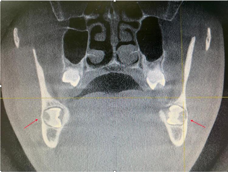 https://cdn.ncbi.nlm.nih.gov/pmc/blobs/e901/8721465/6967845b316b/cureus-0013-00000020858-i06.jpg