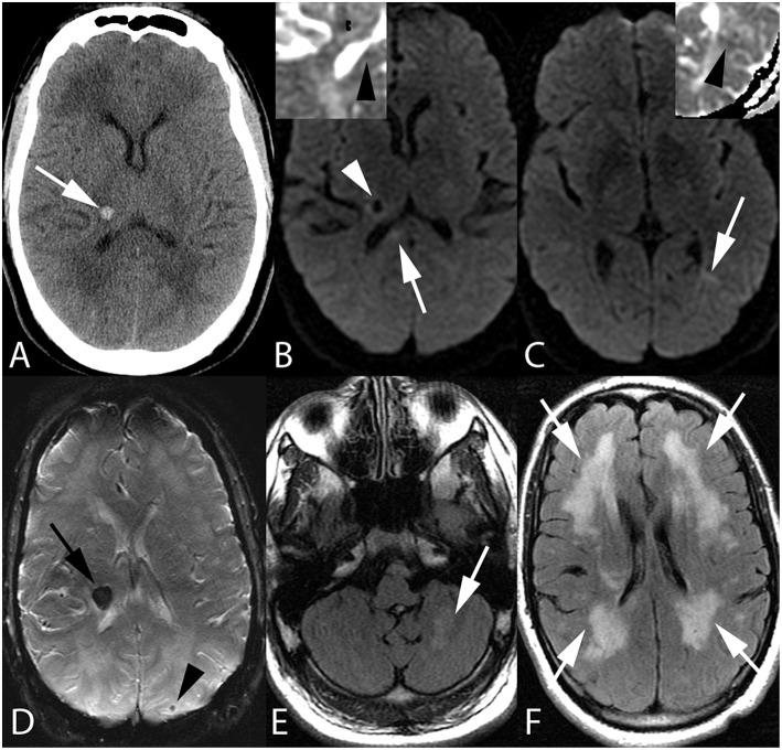https://cdn.ncbi.nlm.nih.gov/pmc/blobs/e92c/6738024/a1ed6031cb27/fneur-10-00964-g0001.jpg