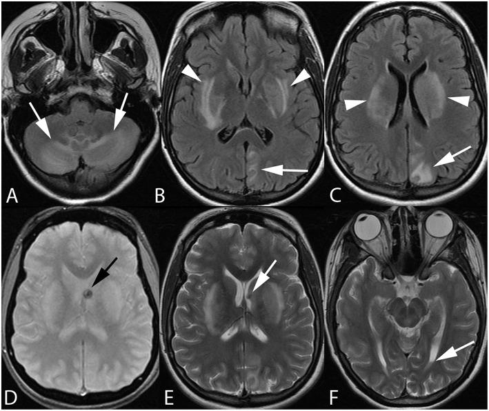 https://cdn.ncbi.nlm.nih.gov/pmc/blobs/e92c/6738024/fb090ced500a/fneur-10-00964-g0002.jpg