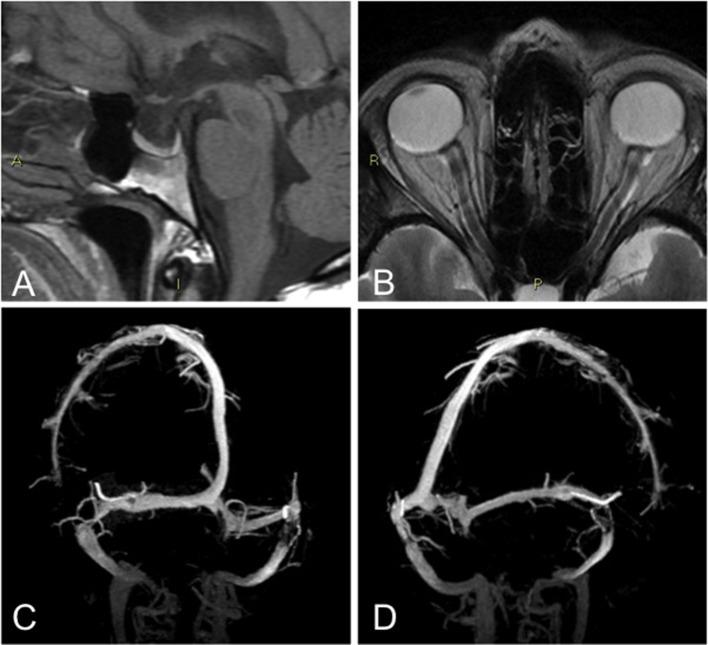 https://cdn.ncbi.nlm.nih.gov/pmc/blobs/e96a/6029151/a505d5fa3c07/fneur-09-00503-g0001.jpg