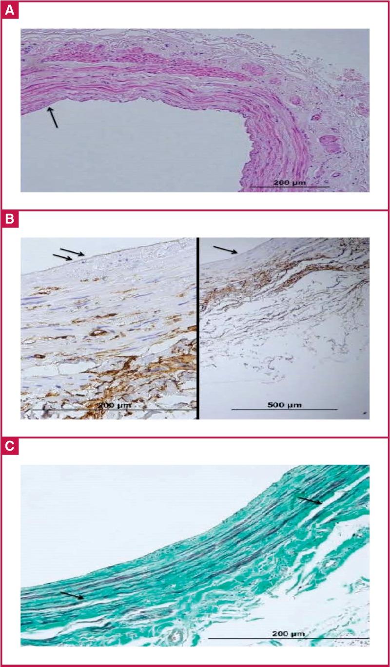 https://cdn.ncbi.nlm.nih.gov/pmc/blobs/e98d/5101453/1a83156df556/cvja-27-161-g003.jpg