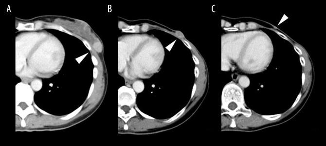 https://cdn.ncbi.nlm.nih.gov/pmc/blobs/ea15/7649113/0250744d6379/amjcaserep-21-e926647-g006.jpg