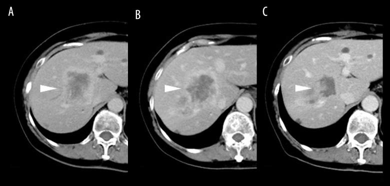 https://cdn.ncbi.nlm.nih.gov/pmc/blobs/ea15/7649113/dfd89e020dfb/amjcaserep-21-e926647-g004.jpg