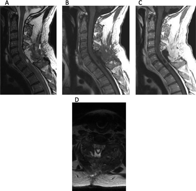 https://cdn.ncbi.nlm.nih.gov/pmc/blobs/ea16/5624373/b98f740fa411/10.1177_2192568217700100-fig3.jpg