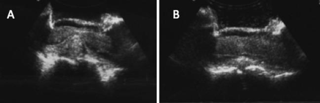 https://cdn.ncbi.nlm.nih.gov/pmc/blobs/ea16/5624373/bc263563fe1b/10.1177_2192568217700100-fig5.jpg